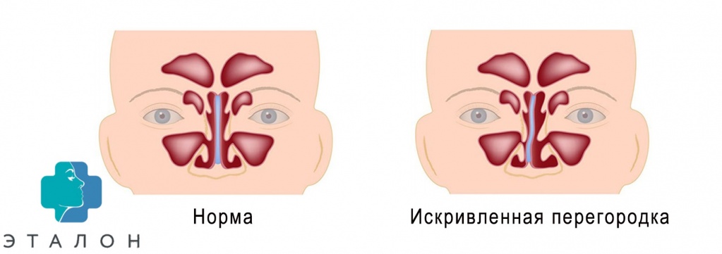 отличия искривленной носовой перегородки от нормальной