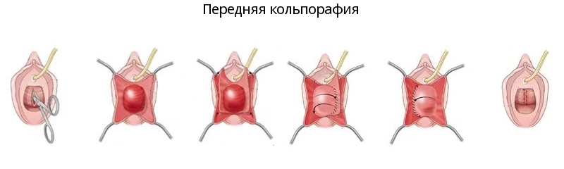 схема проведения передней кольпорафии