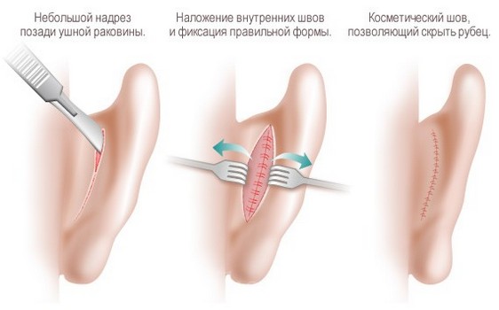 этапы проведения пластики ушей