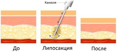 схема до/после выкачивания жира канюлей