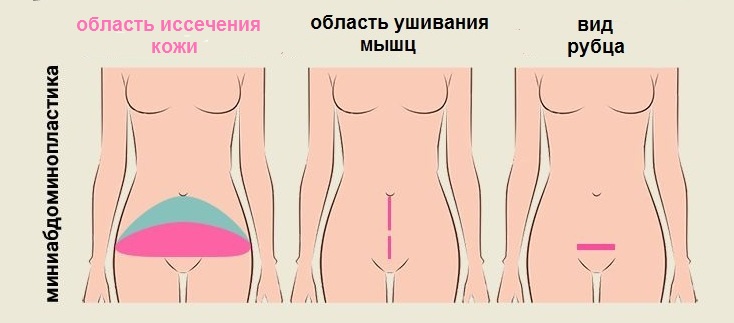 область иссечения кожи и ушивания мышц при мини пластике живота