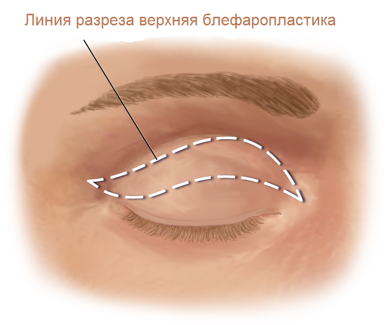 схема зон избыточного отложения подкожно-жировой клетчатки