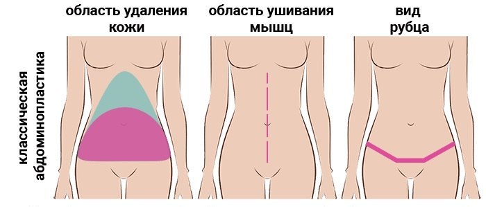 вид рубца и область ушивания мышц при абдоминопластике