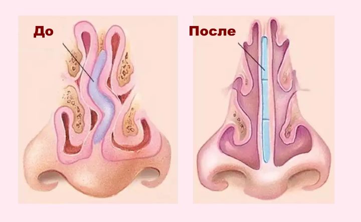 схема до/после исправления носовой перегородки