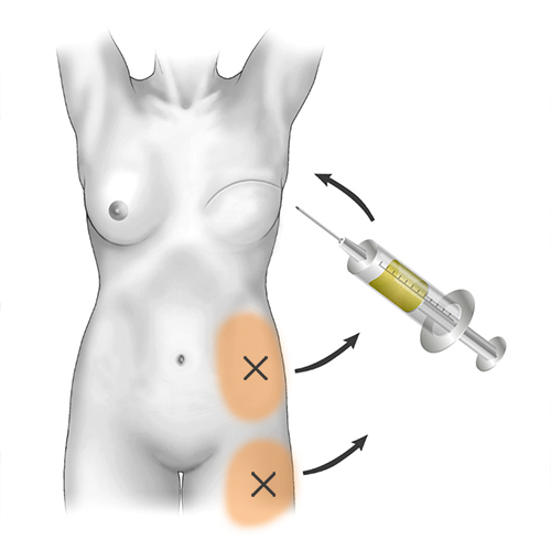 зоны забора жира при увеличении груди методом липофилинга