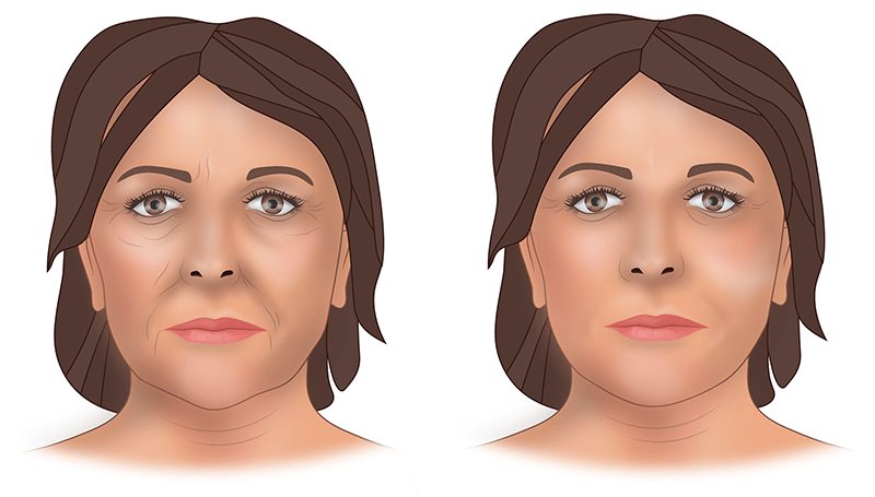 результат проведенного липофилинга лица