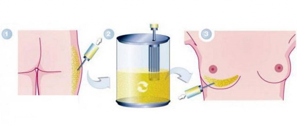 техника проведения липоскульптурирования тела