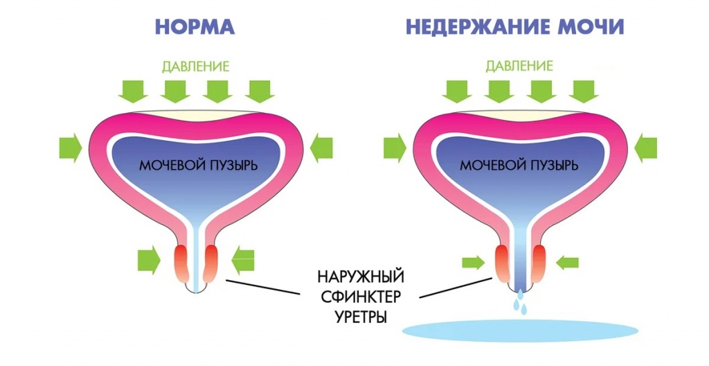 схема возникновения стрессового недержания мочи у женщин