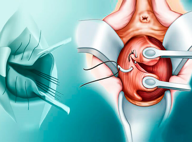 операция по ушиванию влагалища