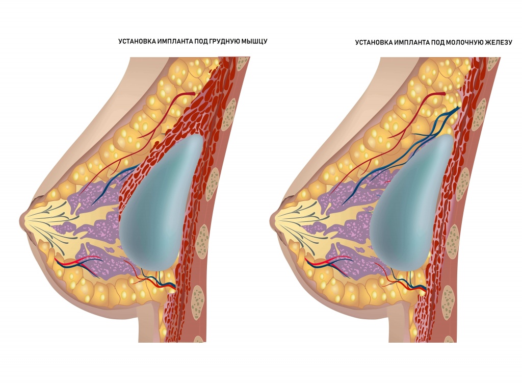 установка грудного импланта под молочную железу и под грудную мышцу