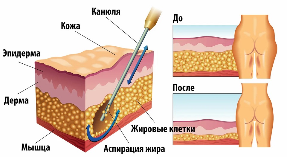 схема проведения липосакции области бедер